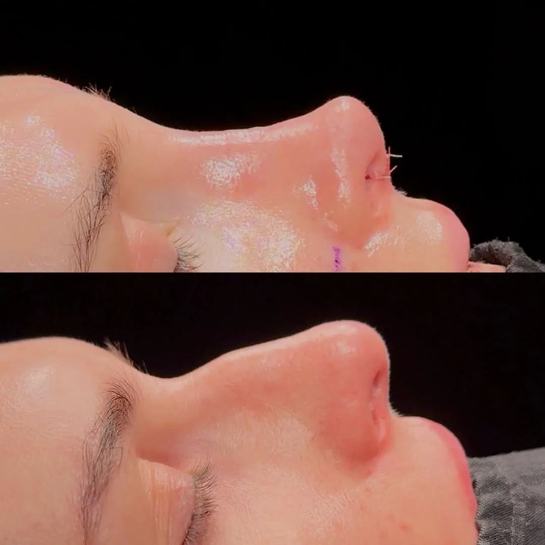 Primary Rhinoplasty