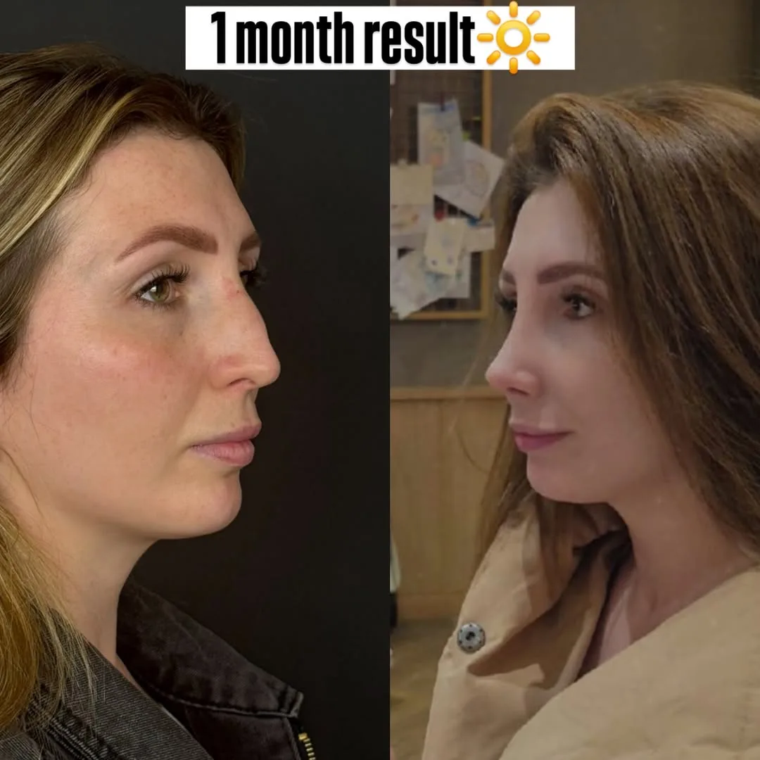 Rhinoplasty: 1 month result