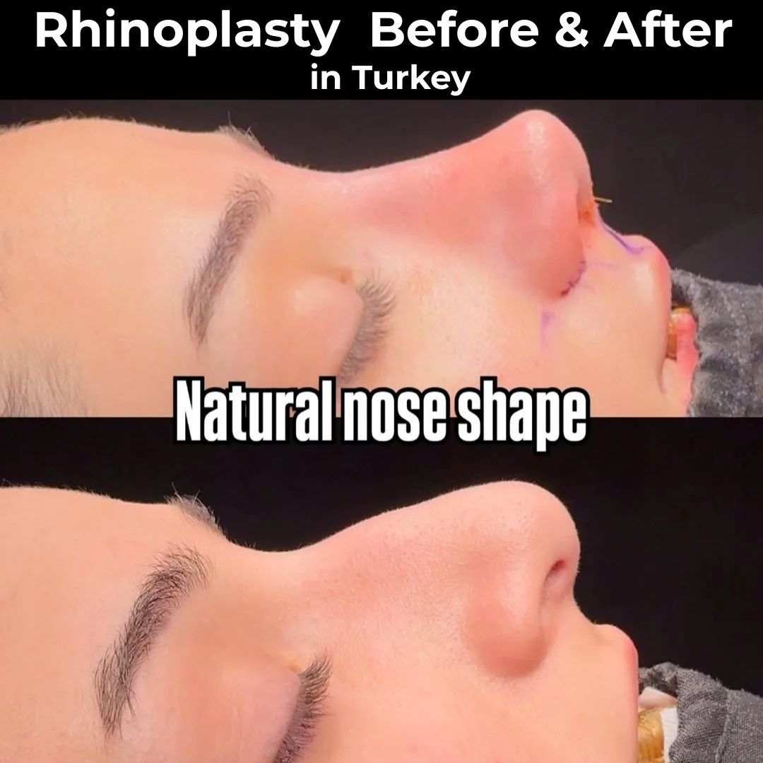 Rhinoplasty (Nose Job) Before and After