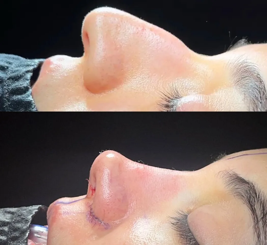 The complexity of your nose job procedure. The complexity of your nose job procedure. in Turkey Antalya