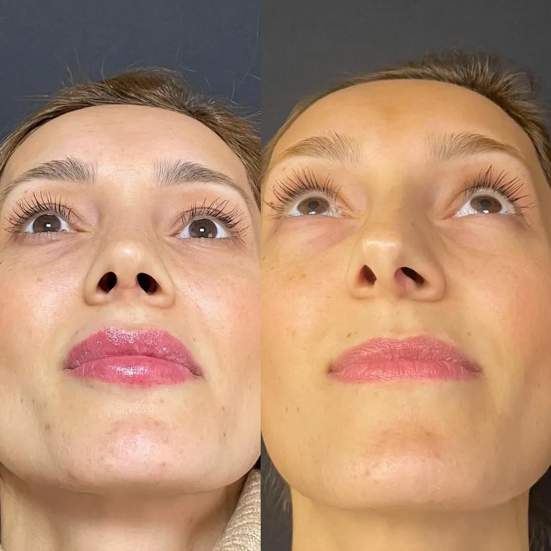 septoplasty-1