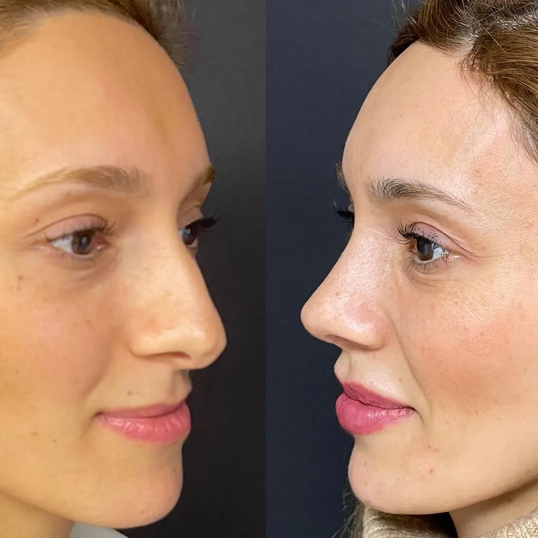 septoplasty-2