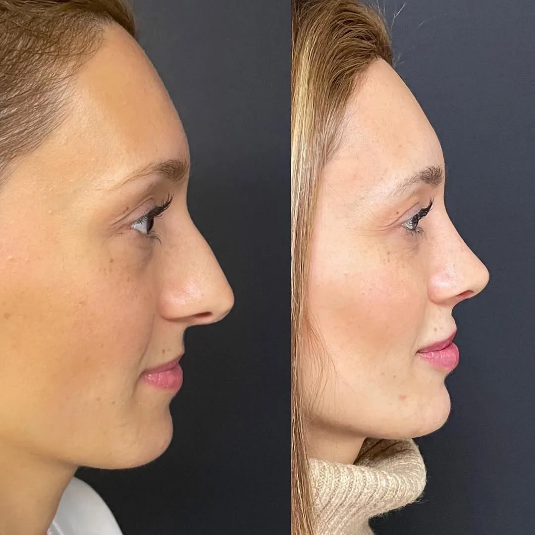 septoplasty-3