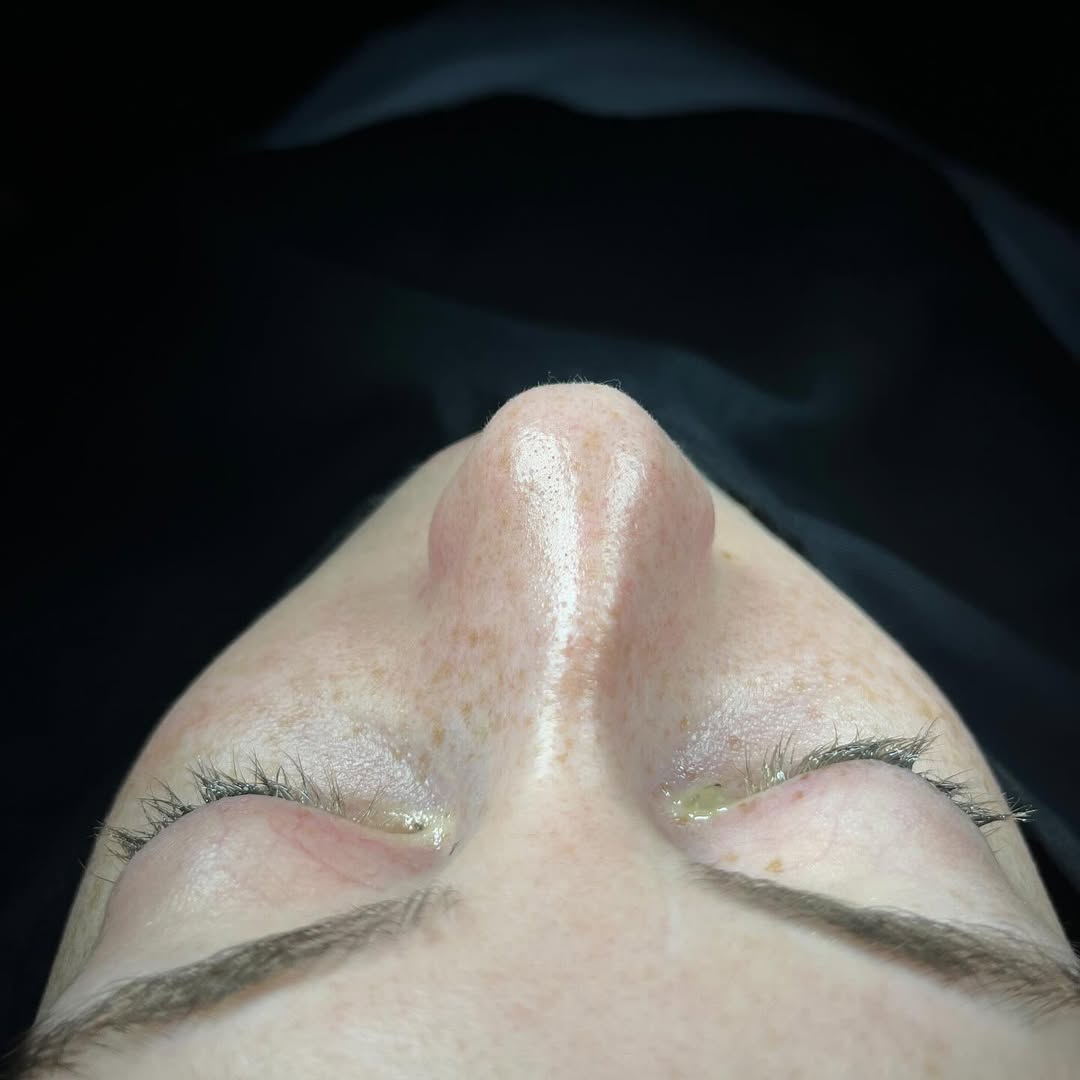 septoplasty-4