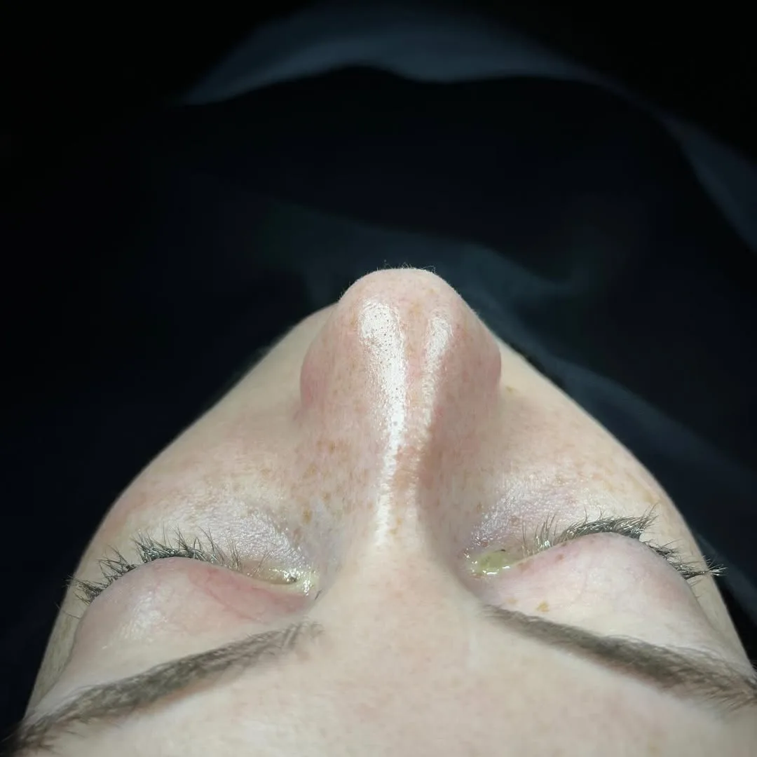 septoplasty-4