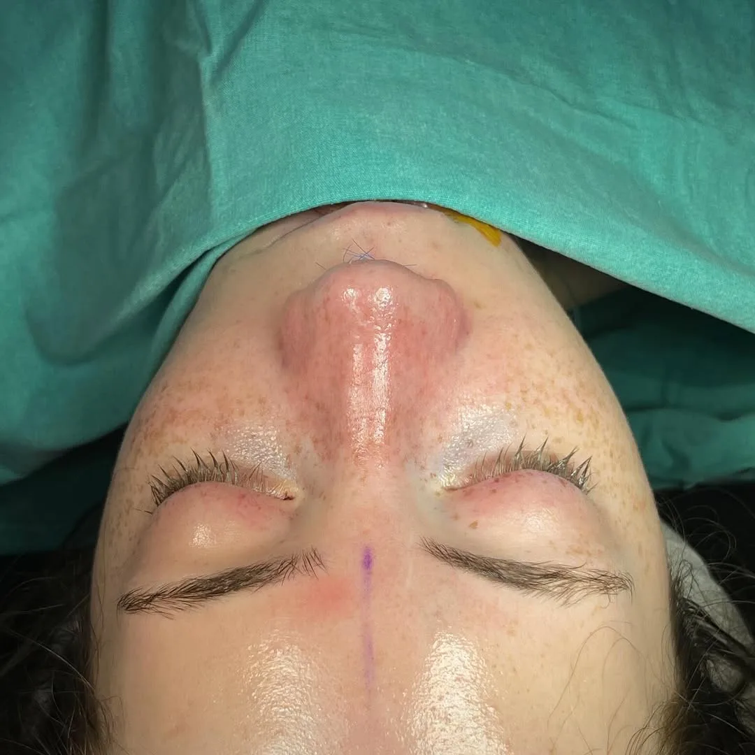 septoplasty-5