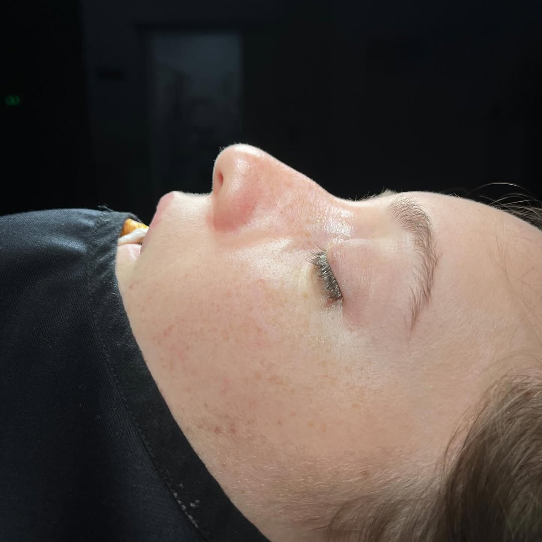 septoplasty-6