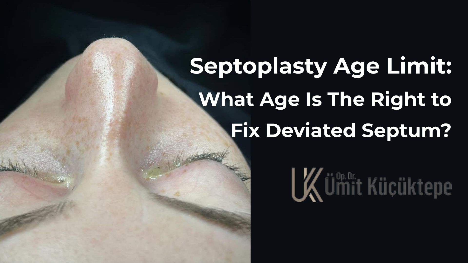 Septoplasty age limit Septoplasty age limit