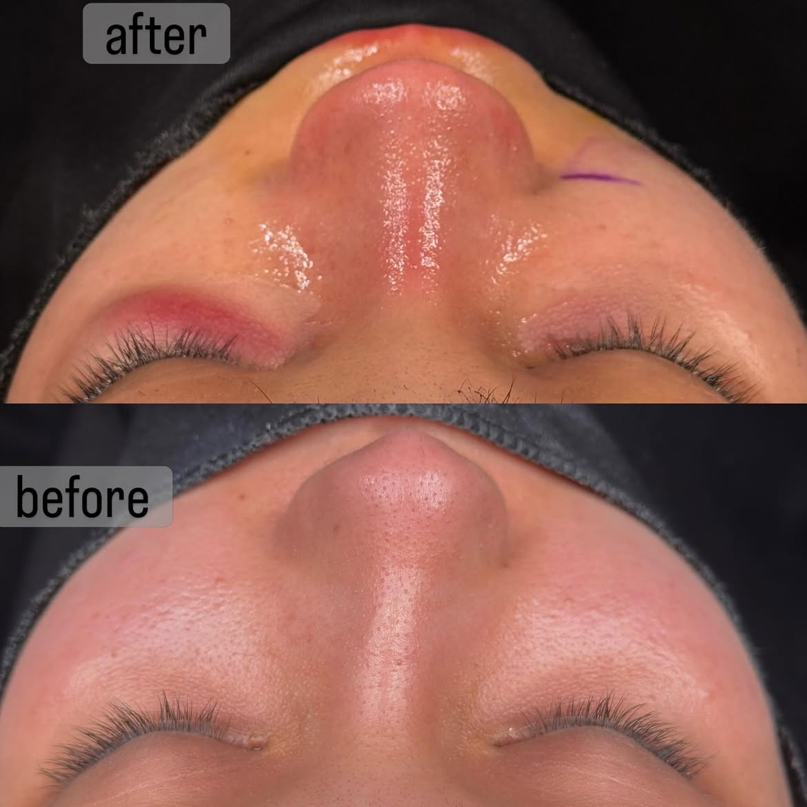 septorhinoplasty-turkey-antalya
