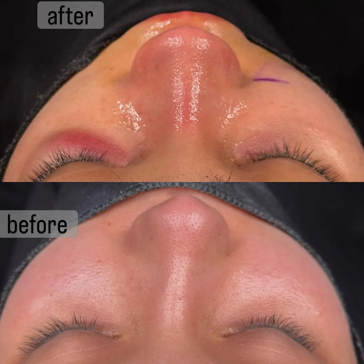 septorhinoplasty-turkey-antalya