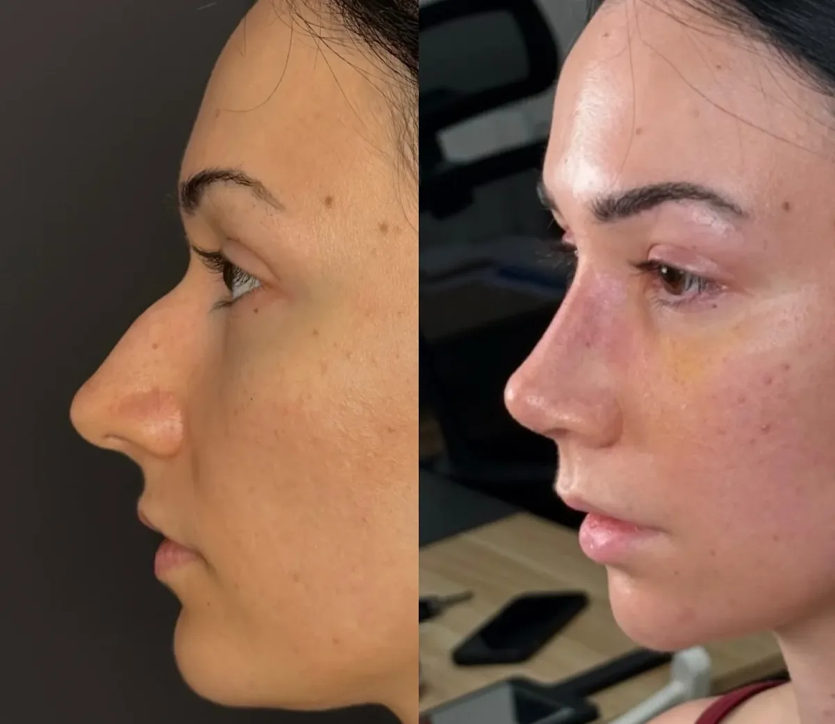 Rhinoplasty in Turkey, Antalya