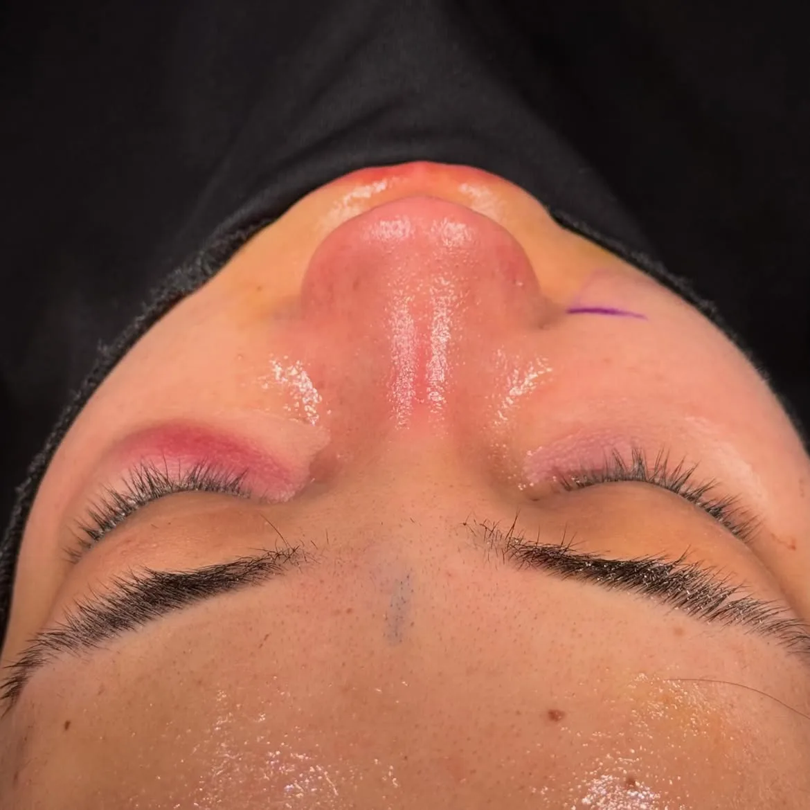 Septorhinoplasty before and after in Antalya Turkey-3 