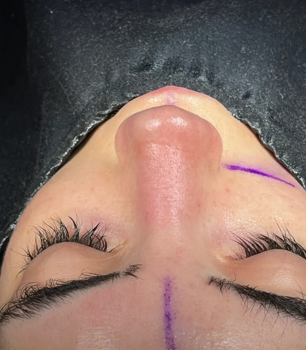 Septorhinoplasty before and after in Antalya Turkey-7 