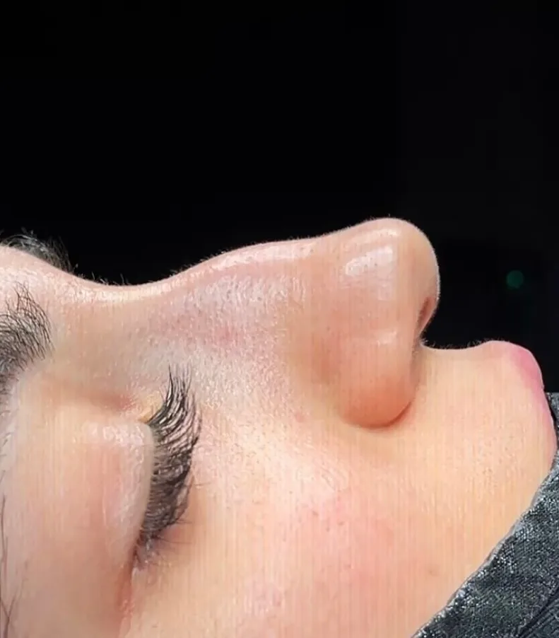 Septorhinoplasty before and after in Antalya Turkey-8 