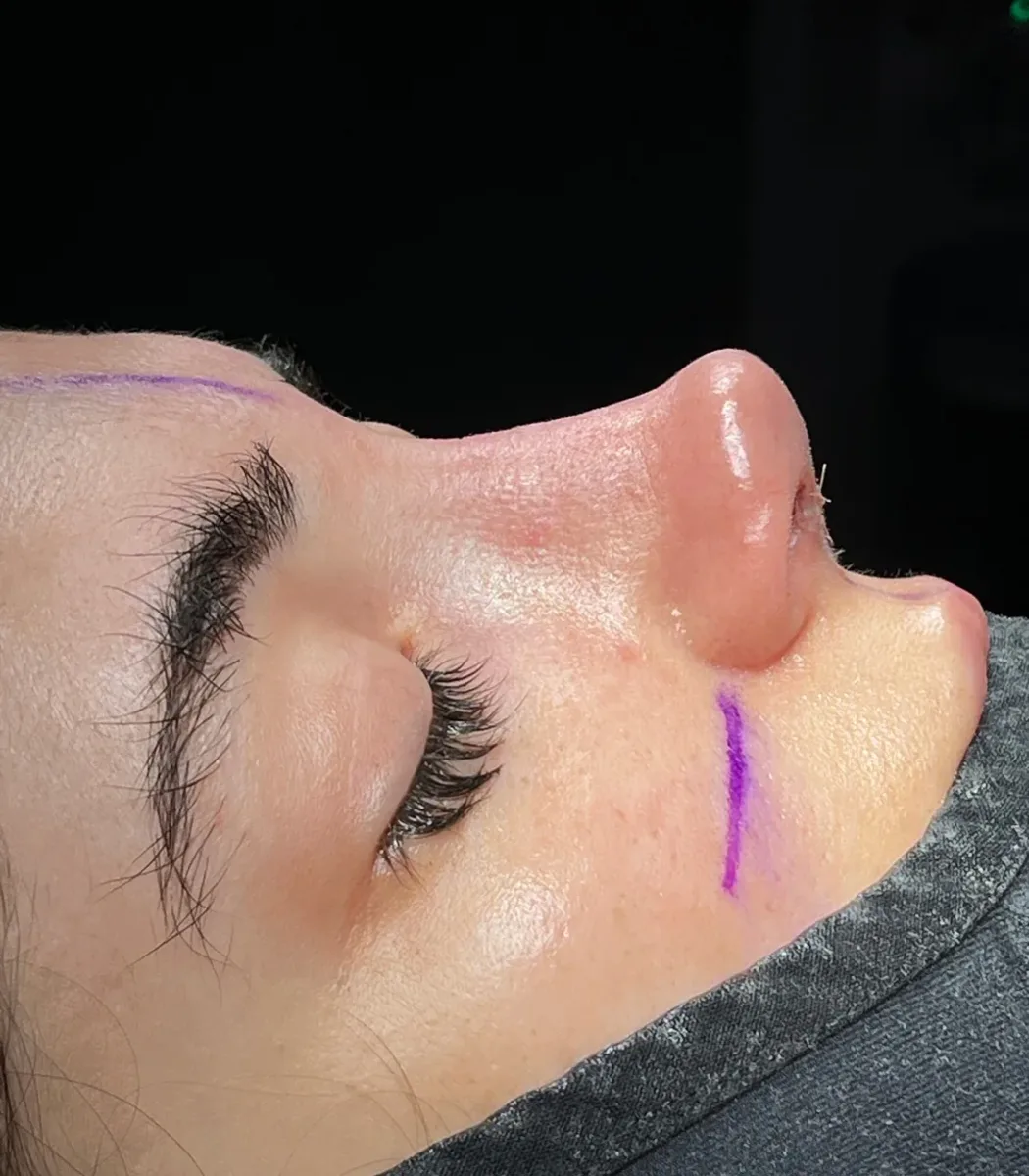 Septorhinoplasty before and after in Antalya Turkey-9 