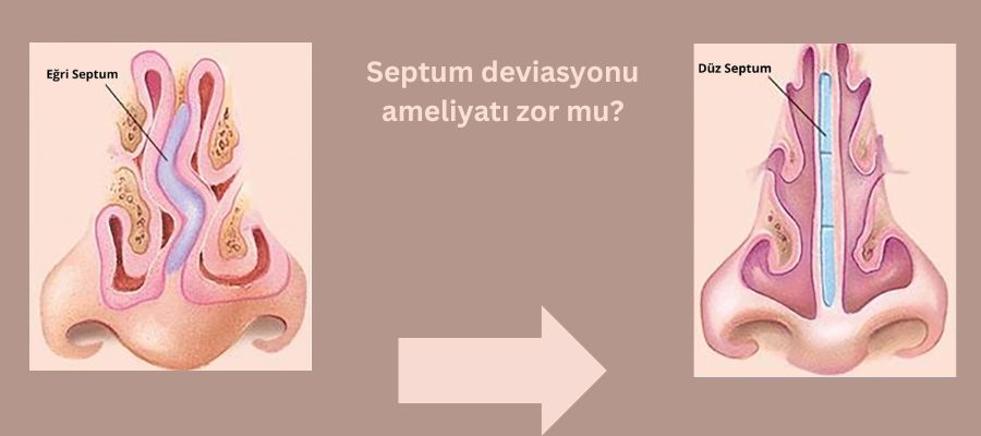 Septum deviasyonu ameliyatı zor mu? Antalya