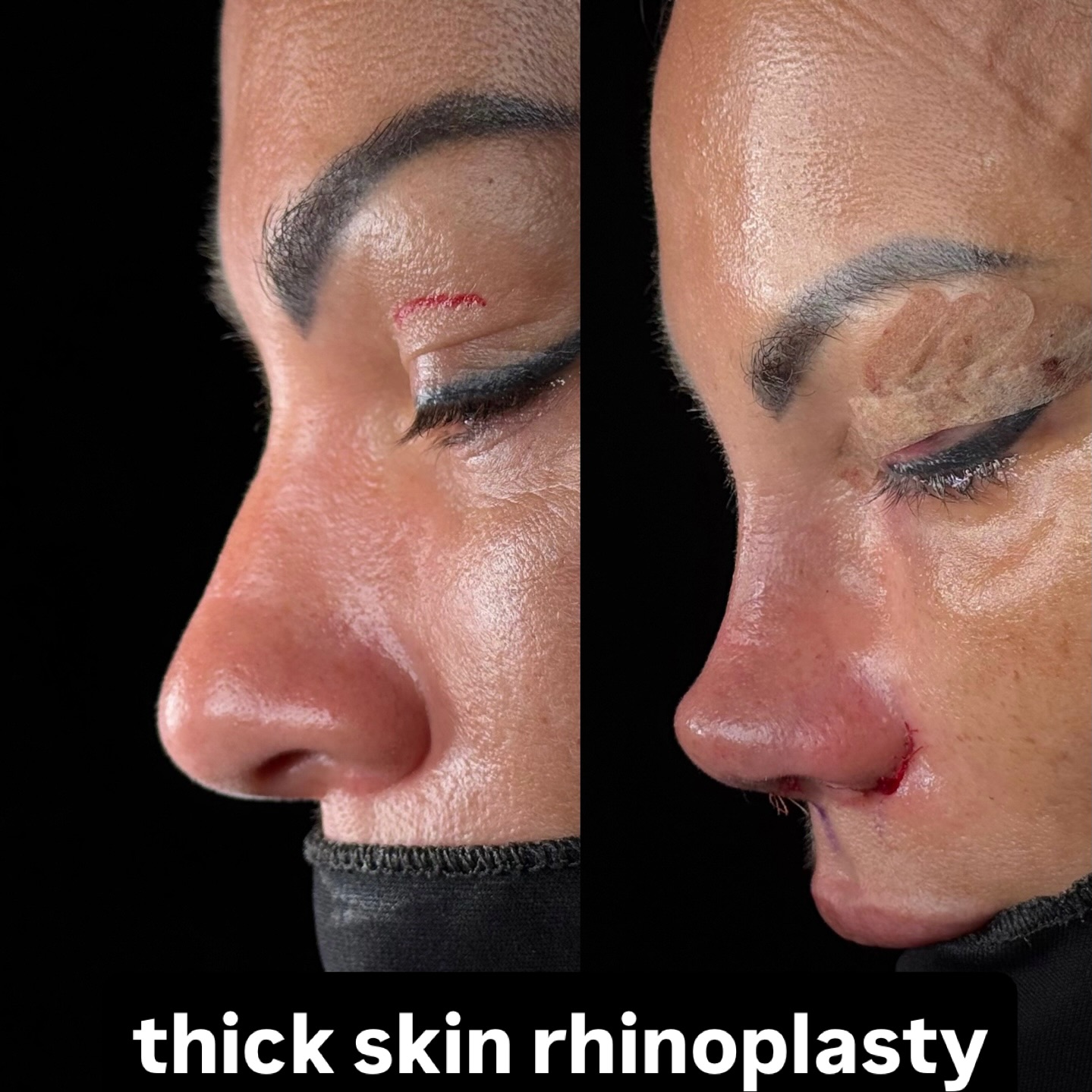 Thick skin rhinoplasty before and after 1
