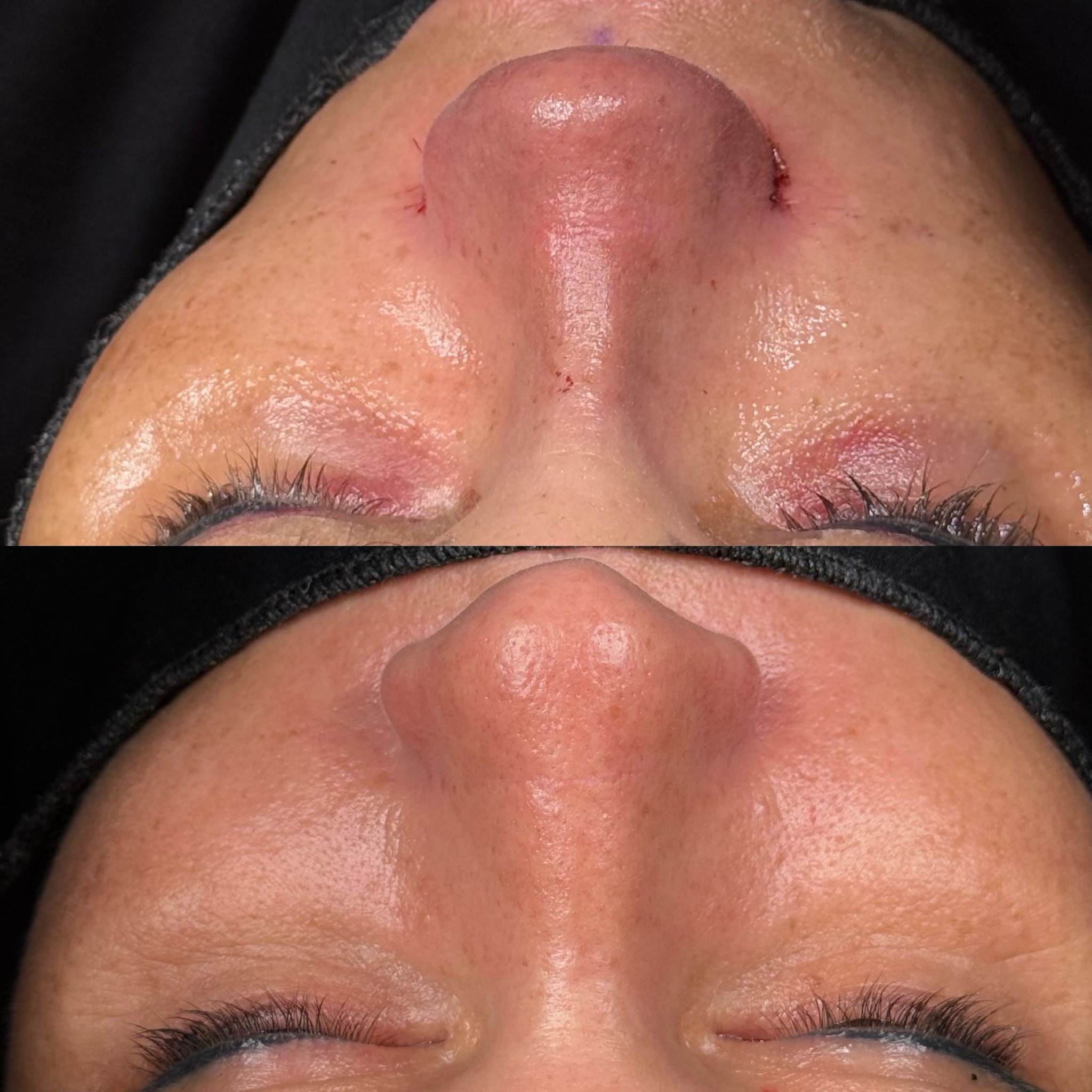 Thick skin rhinoplasty before and after 2
