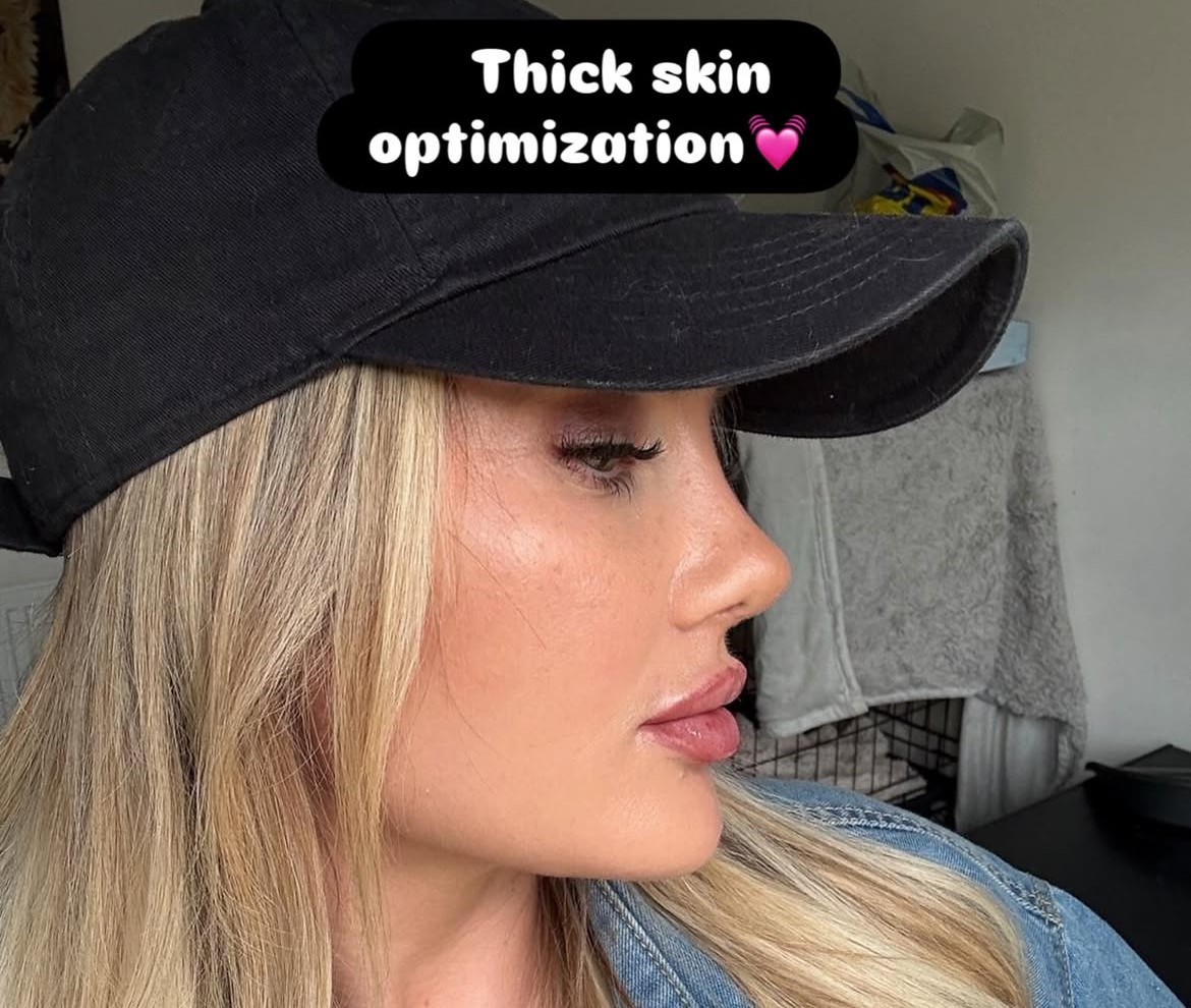 Thick skin rhinoplasty result