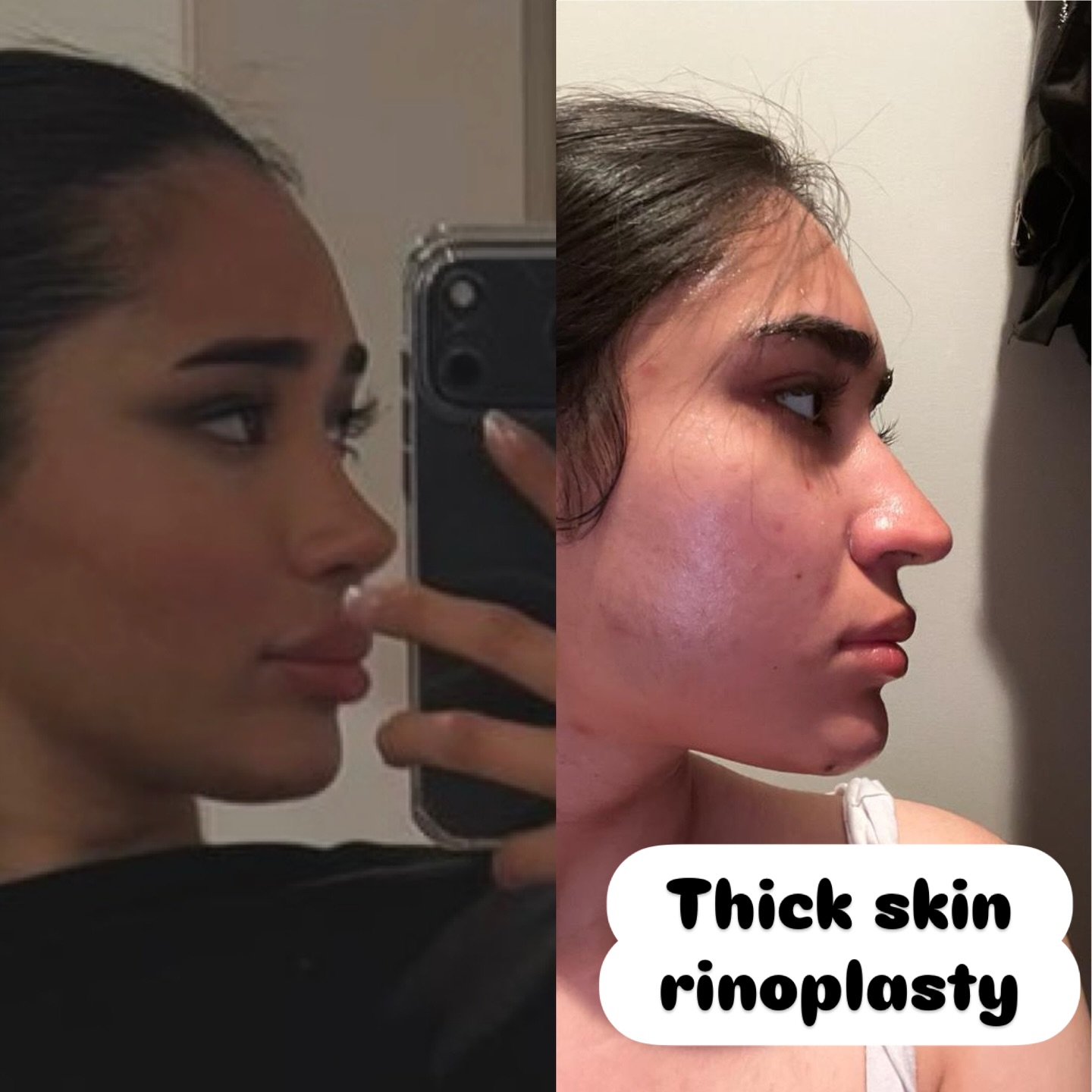 Thick skin rhinoplasty before and after 3