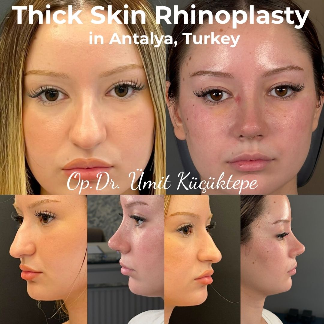 Thick skin rhinoplasty nasal tip evaluation