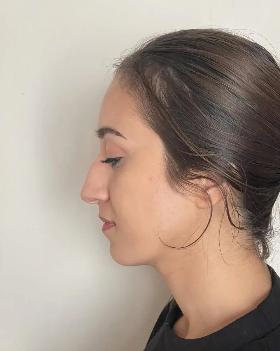 ultrasonic-rhinoplasty-1
