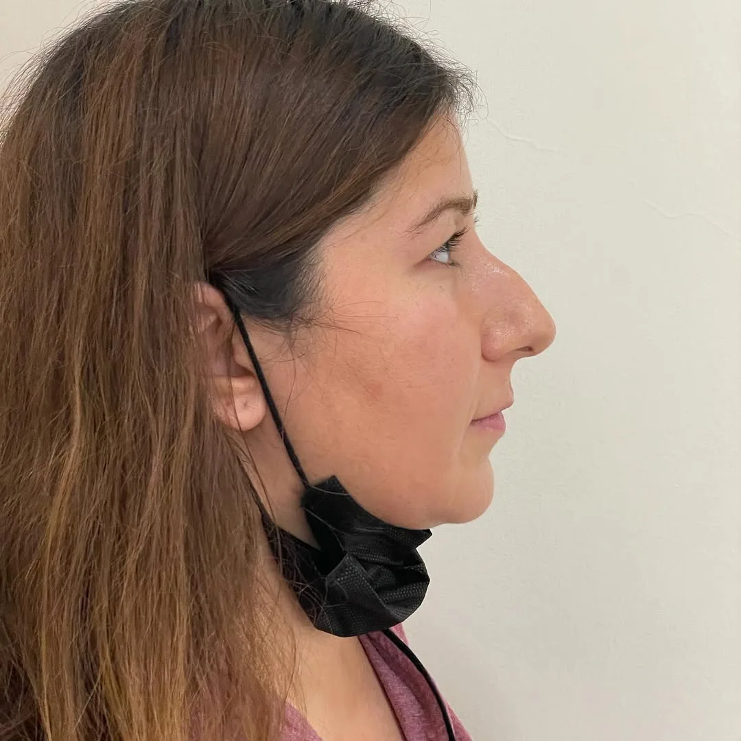 piezo-rhinoplasty-1