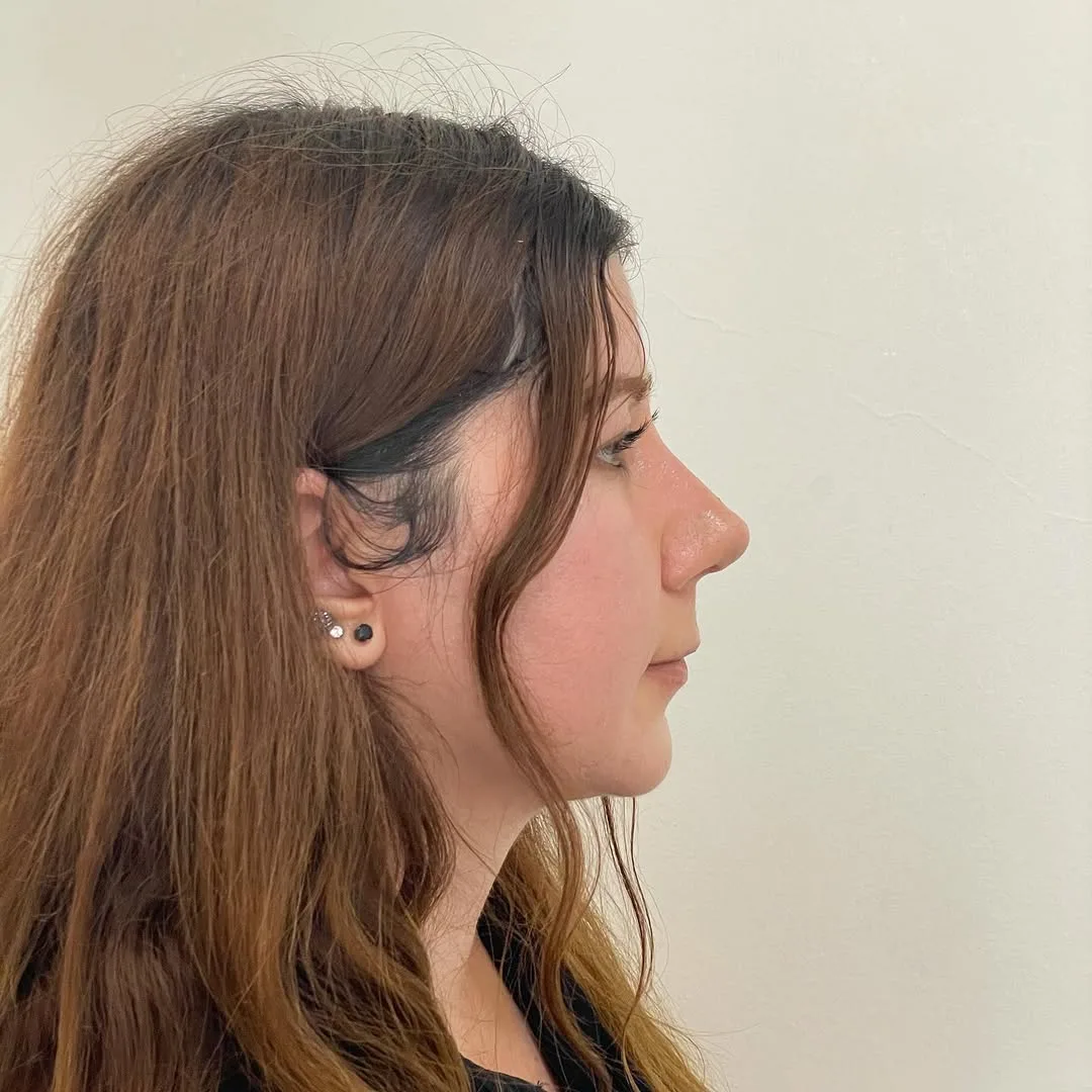 piezo-rhinoplasty-2