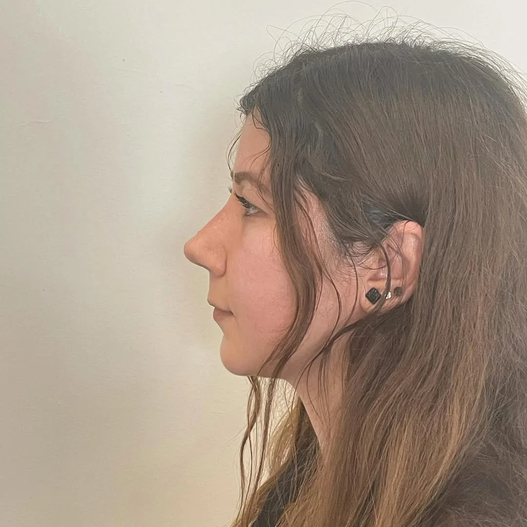 piezo-rhinoplasty-4