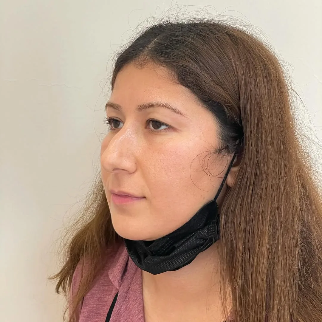 piezo-rhinoplasty-5