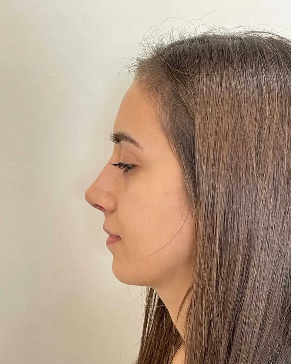 ultrasonic-rhinoplasty-2