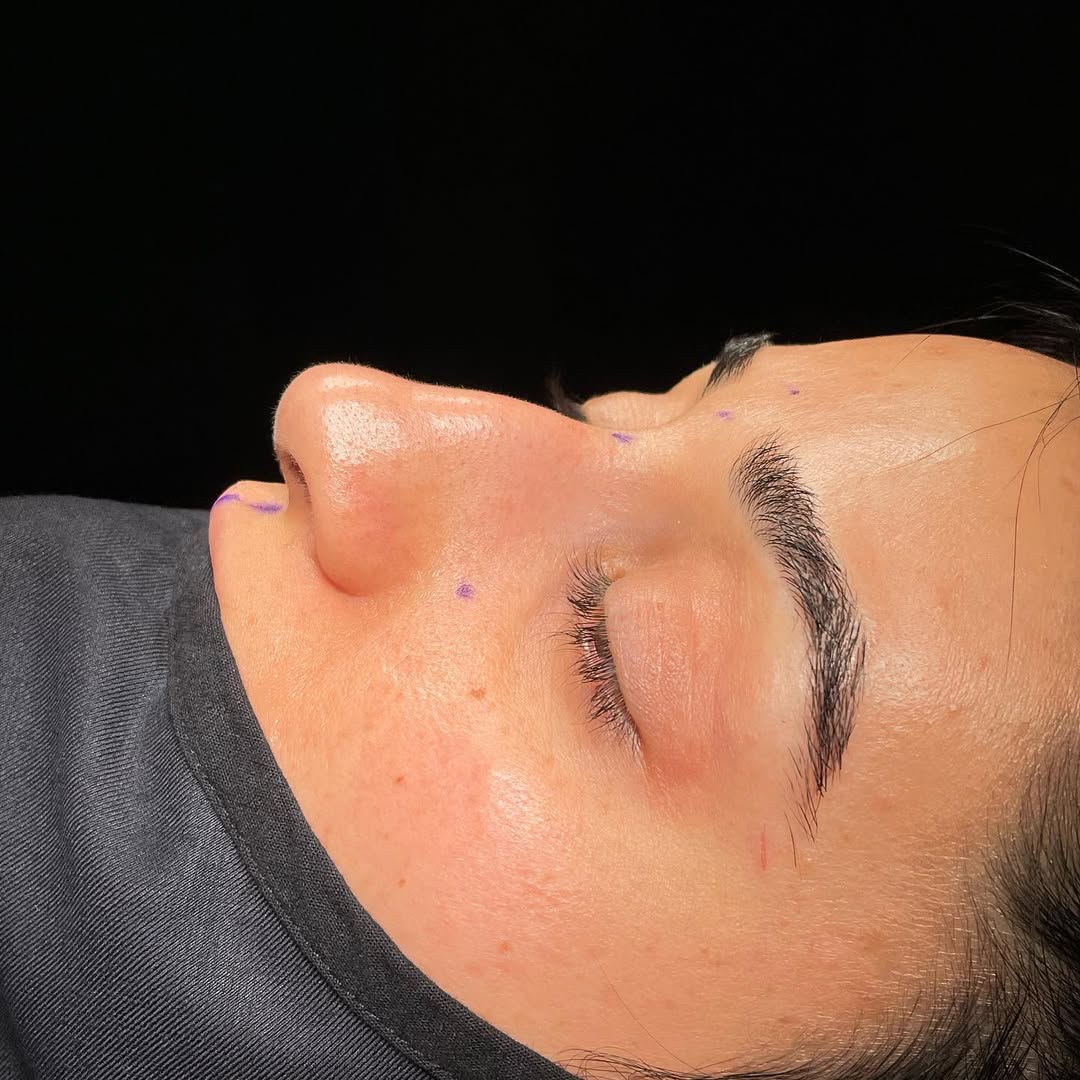 ultrasonic-rhinoplasty-1