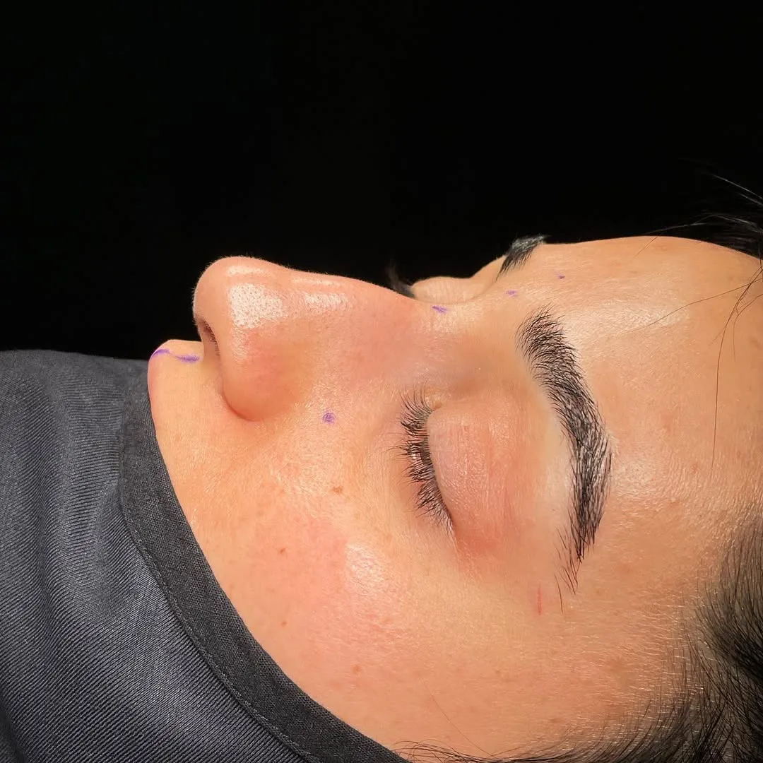 ultrasonic-rhinoplasty-1
