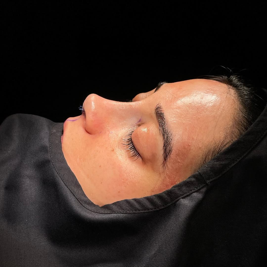 ultrasonic-rhinoplasty-2