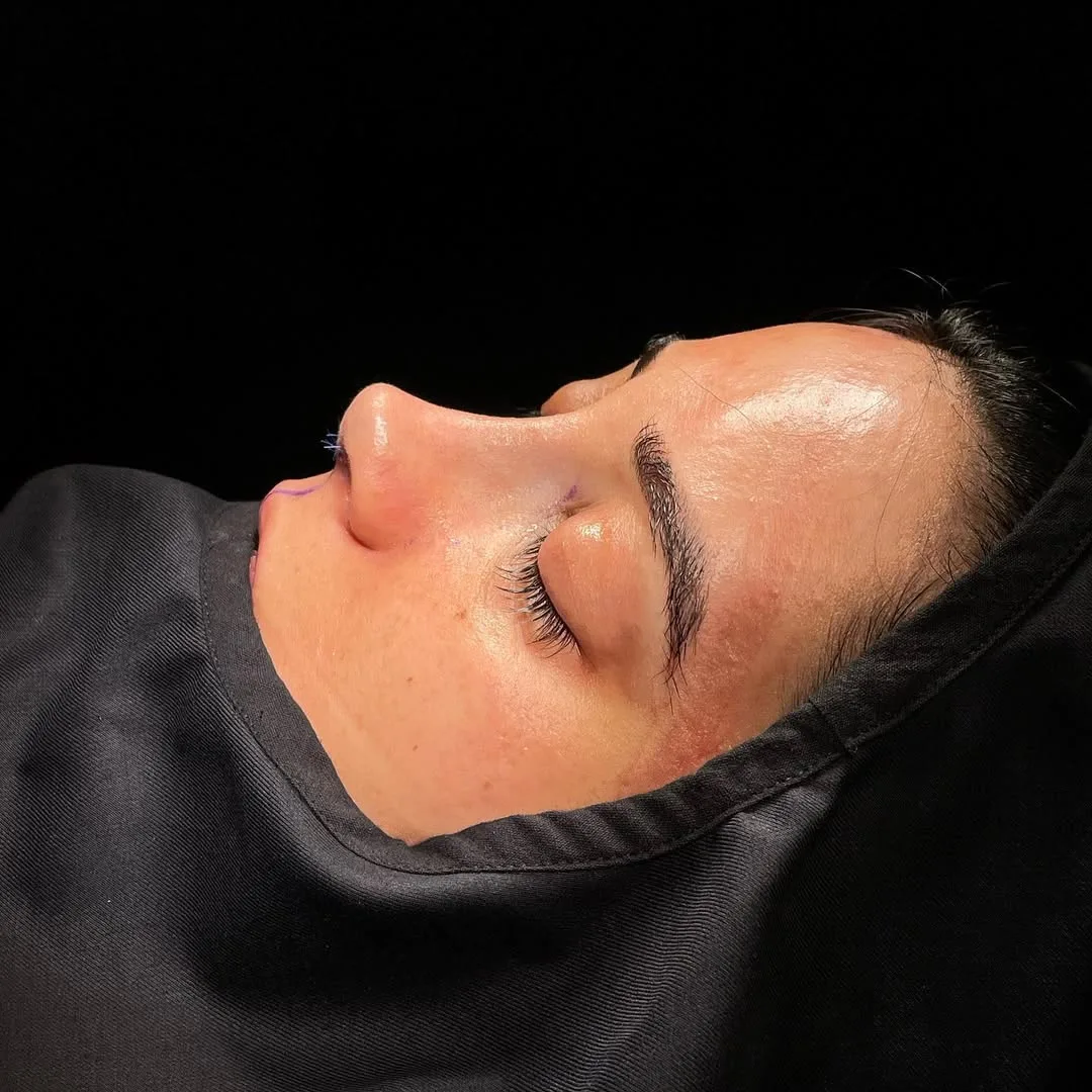 ultrasonic-rhinoplasty-2