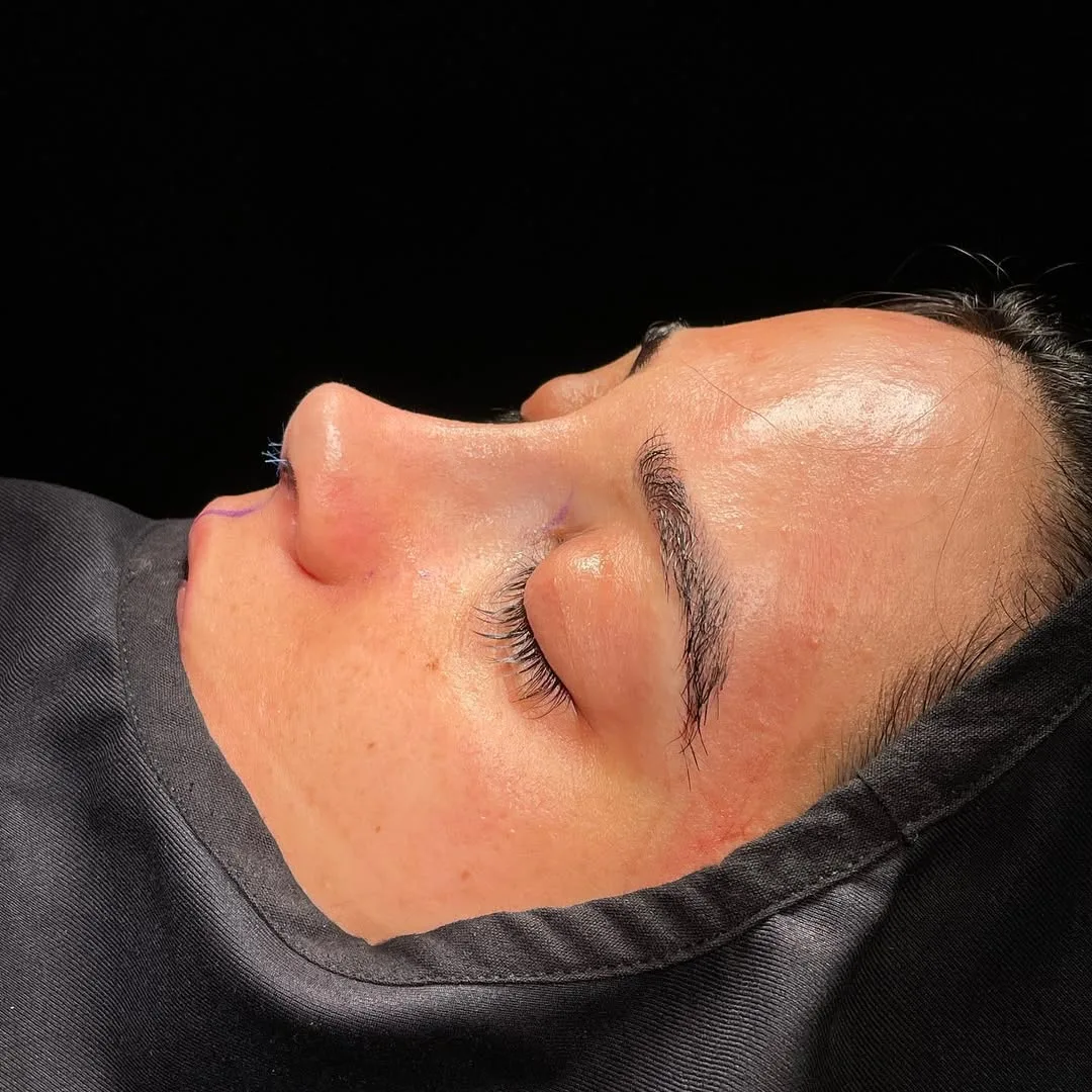 ultrasonic-rhinoplasty-3