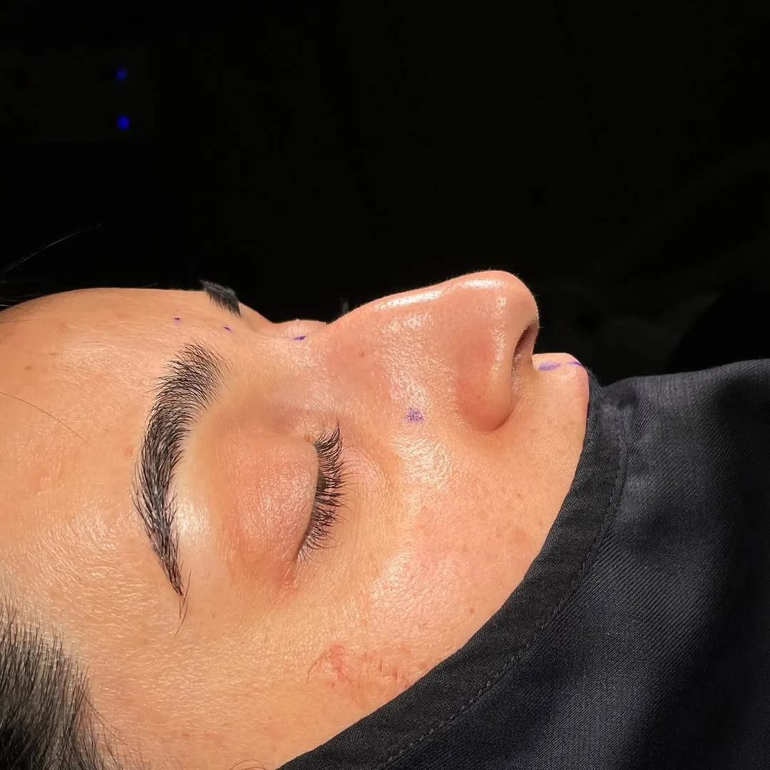ultrasonic-rhinoplasty-4