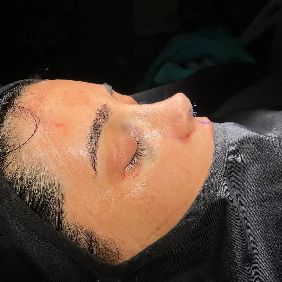 ultrasonic-rhinoplasty-5
