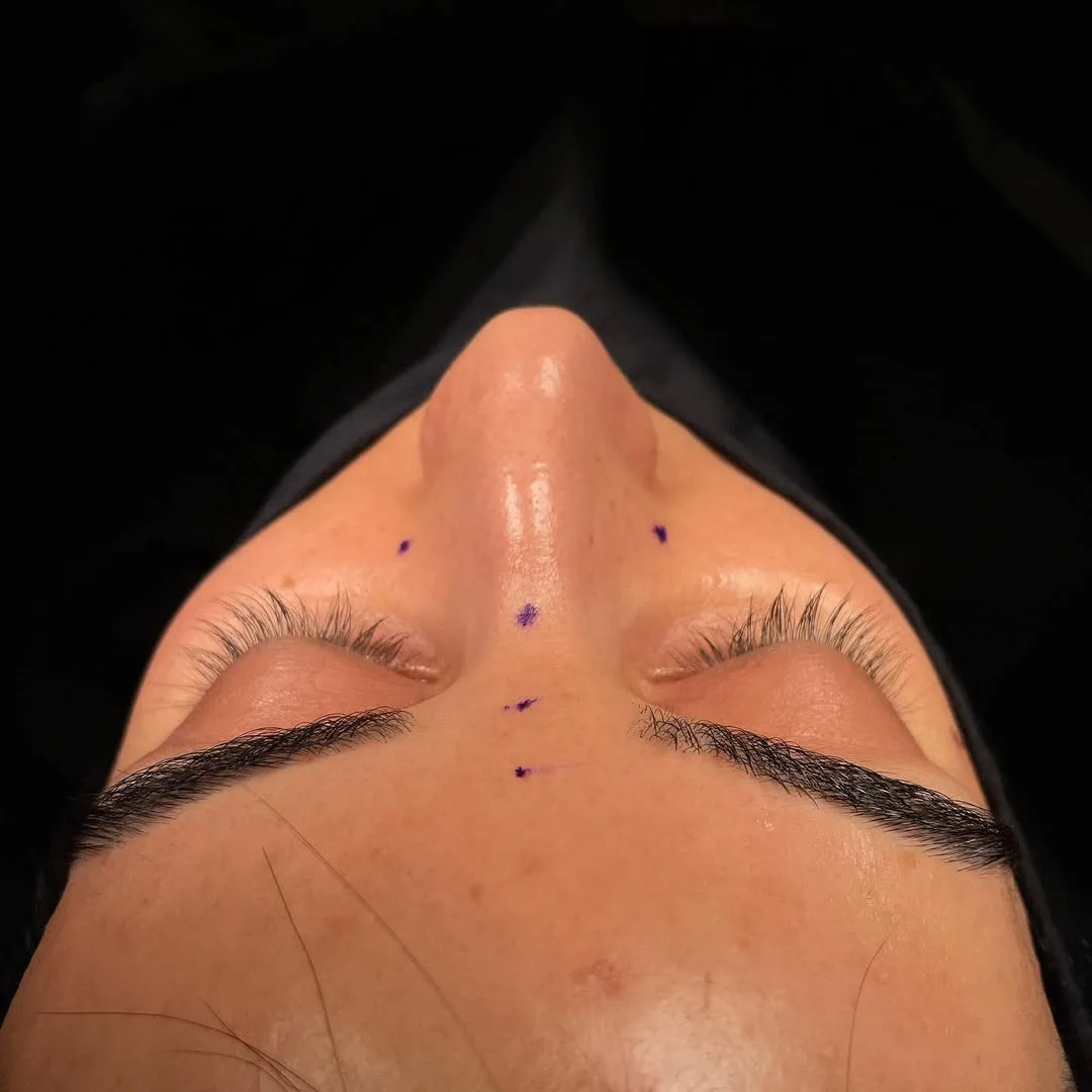 ultrasonic-rhinoplasty-6