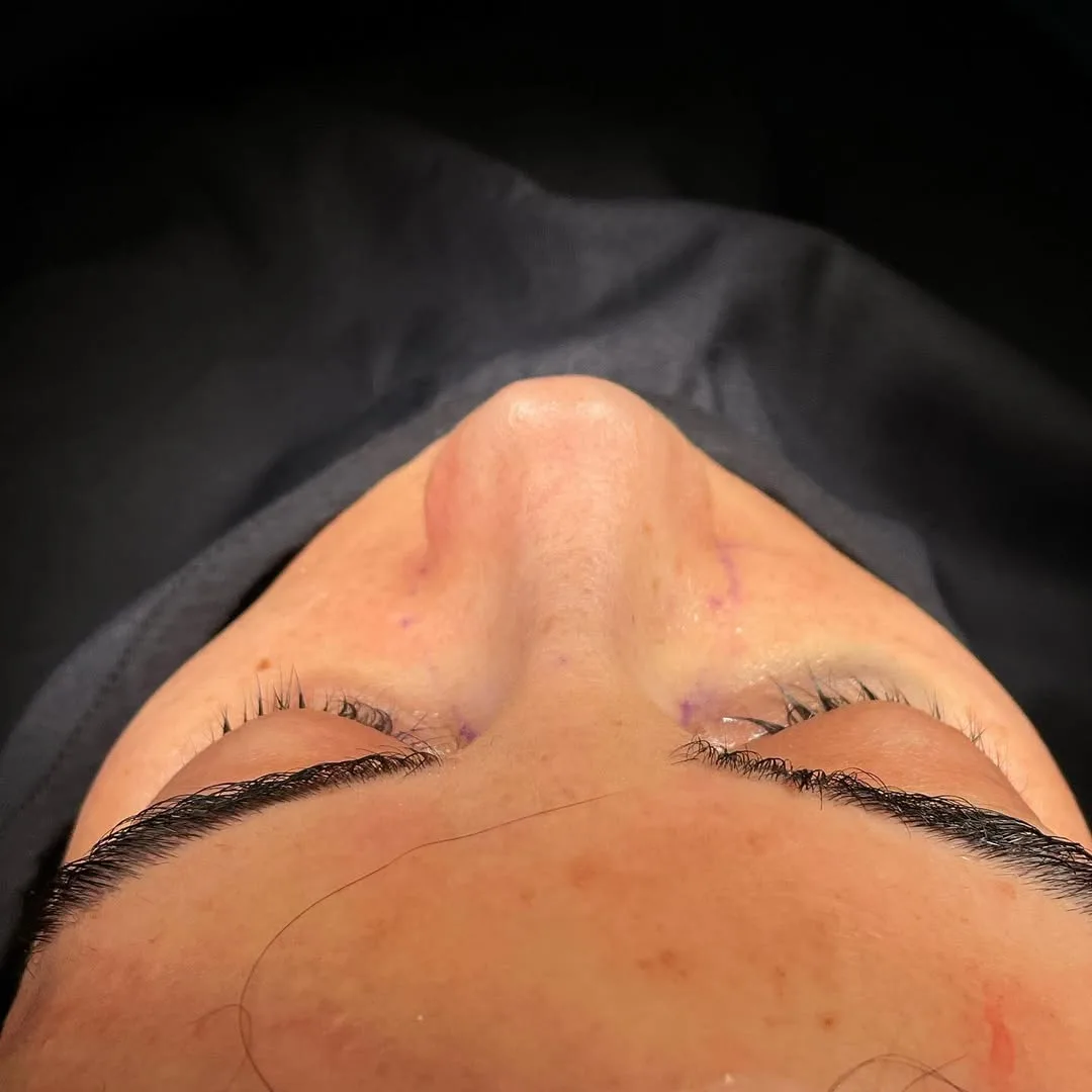 ultrasonic-rhinoplasty-7