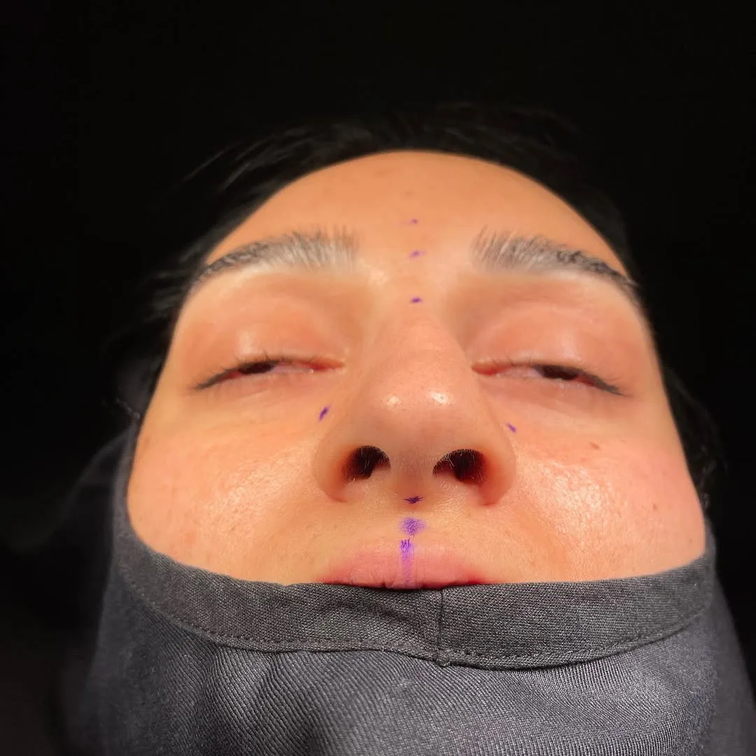 ultrasonic-rhinoplasty-8