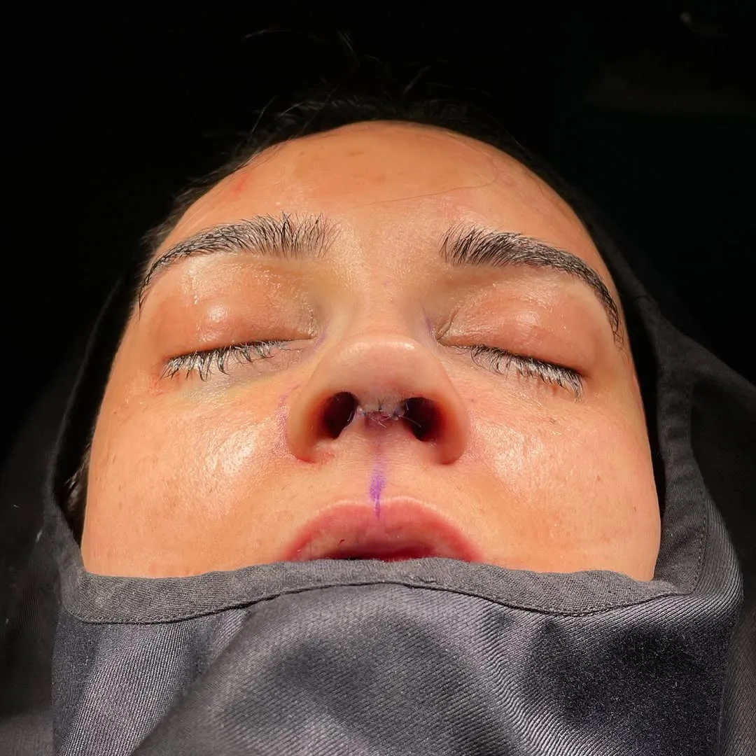 ultrasonic-rhinoplasty-9