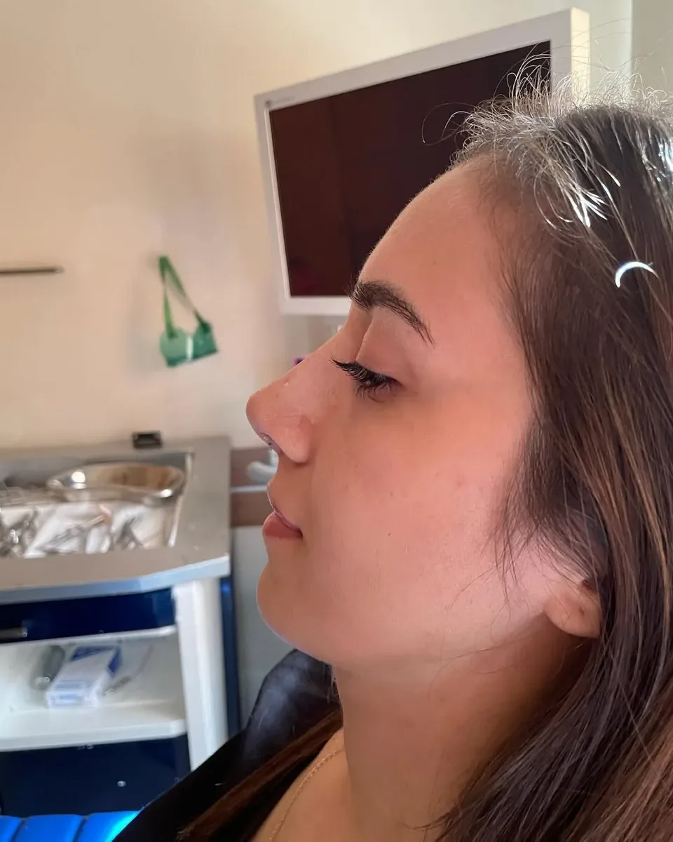 ultrasonic-rhinoplasty-3
