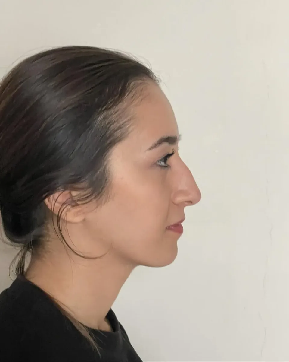 ultrasonic-rhinoplasty-4
