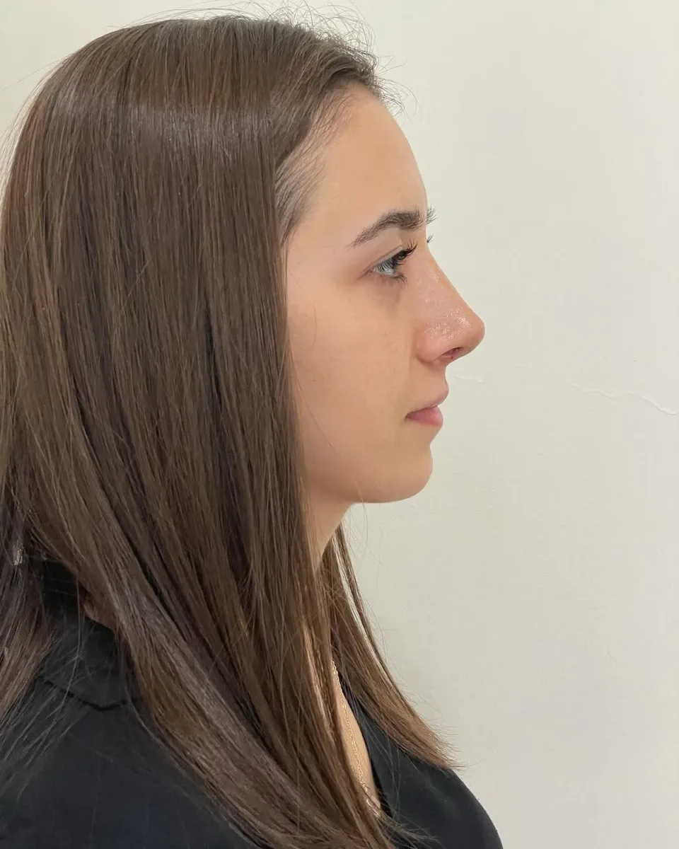 ultrasonic-rhinoplasty-5