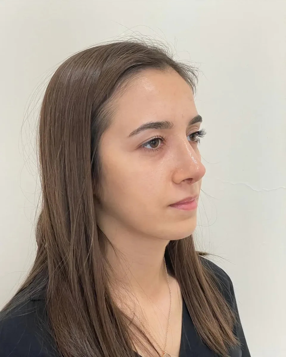 ultrasonic-rhinoplasty-9