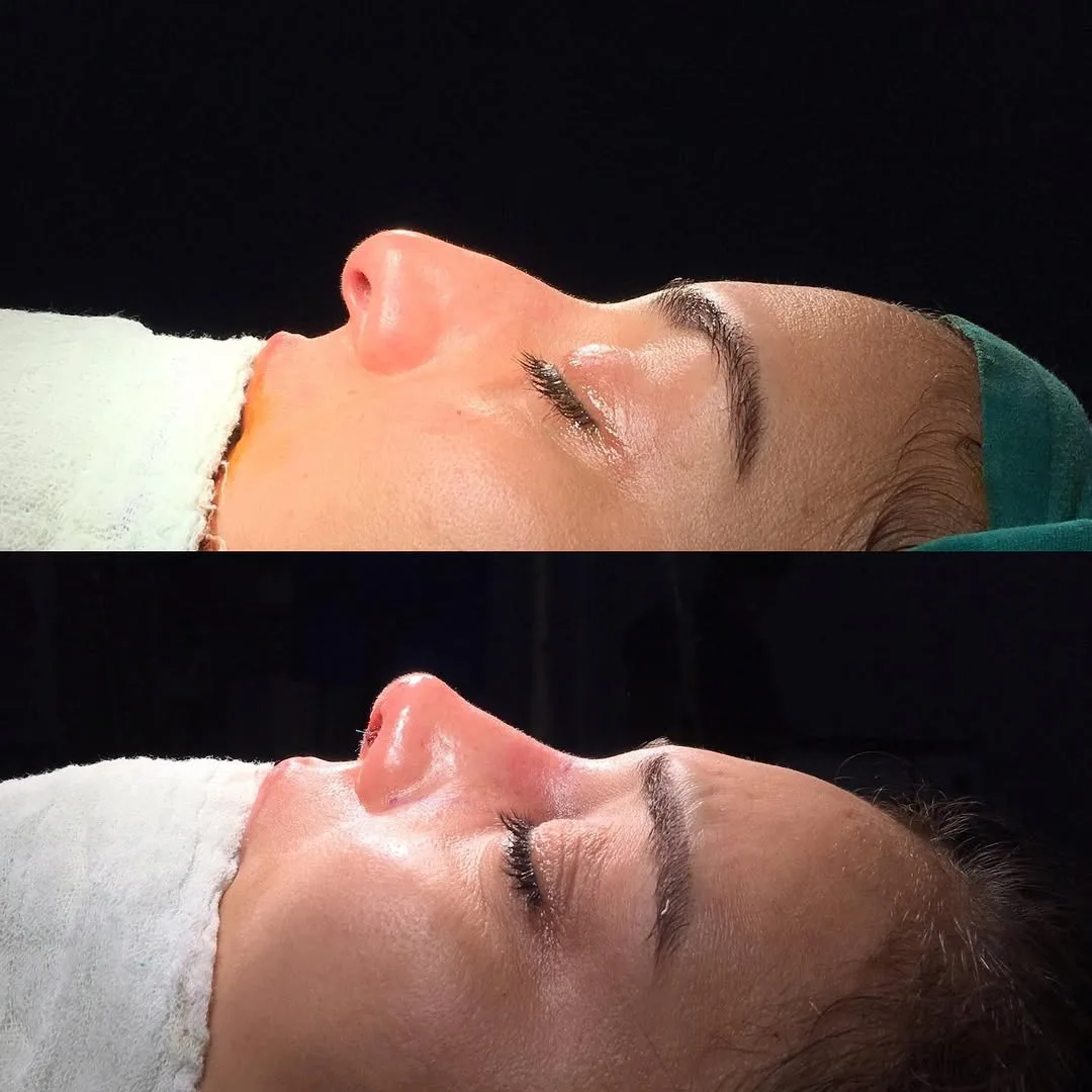 ultrasonic-rhinoplasty-1