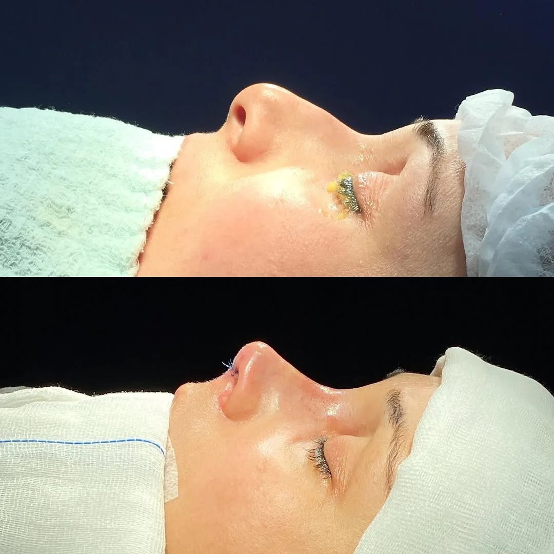 ultrasonic-rhinoplasty-2