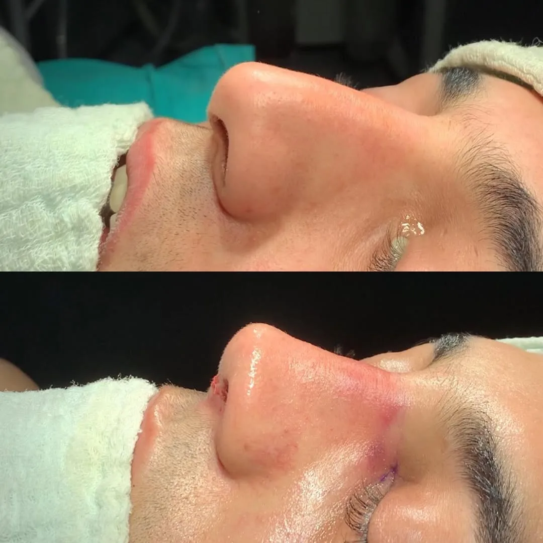 ultrasonic-rhinoplasty-3