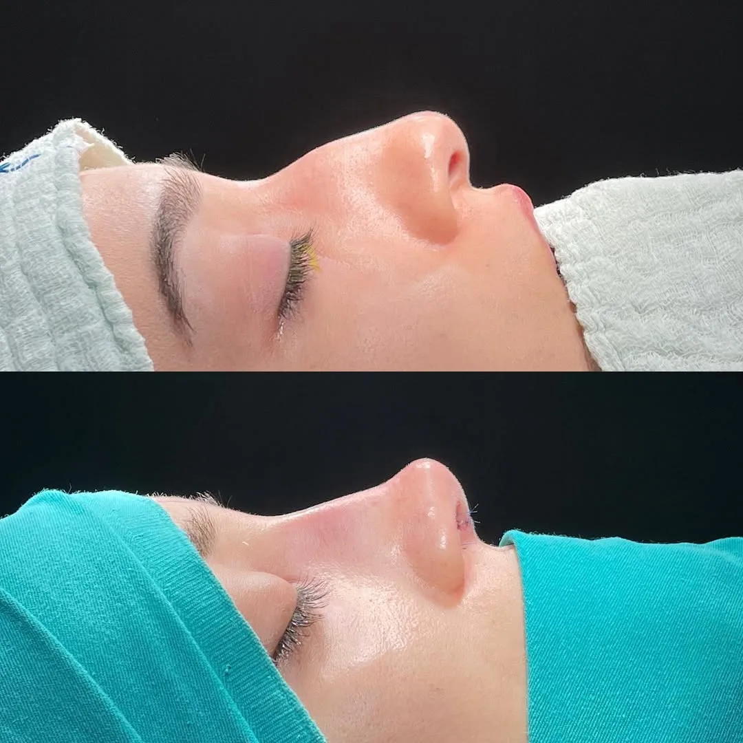 ultrasonic-rhinoplasty-4